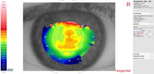 Topographie Bild für die Anpassung weicher Kontaktlinsen.